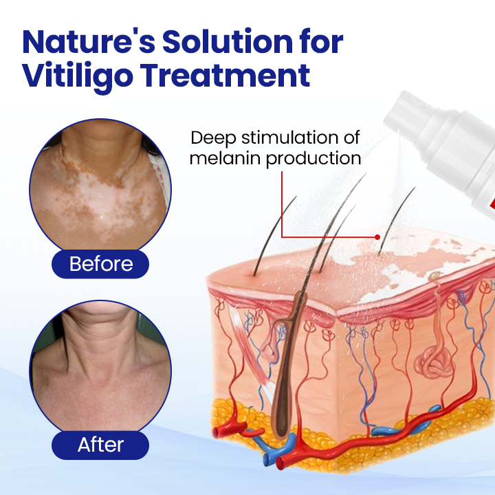 Lovilds® Vitiligo Treatment Spray